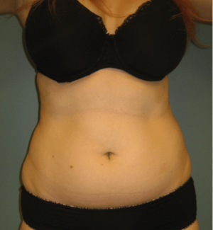 liposuction-example-before